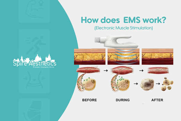 EMS treatment for post pregnancy weight loss treatment Somerset
