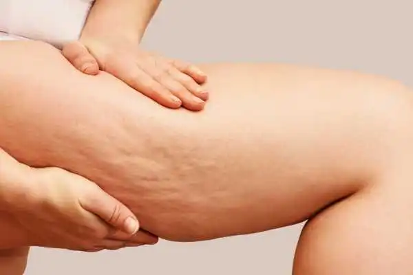 Image of woman showing leg with cellulite Somerset