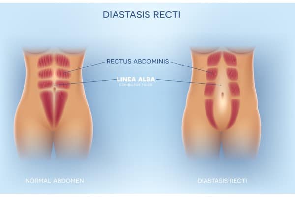 What Non-Surgical Options Are Available for Diastasis Recti Somerset ?
