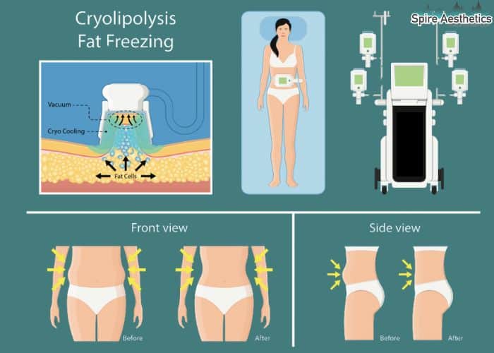 Image of diet and fat freezing combined for best results for Spire Aesthetics Somerset