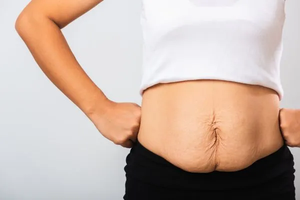 Image of a woman's stomach after weight loss with sagging skin following a gastric band Somerset