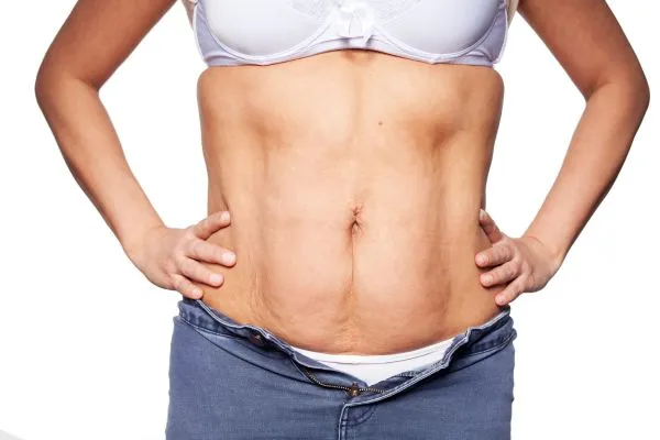 sagging skin on woman's stomach after weight loss injections Somerset