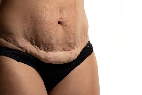 Image of womans stomach after weight loss injections Somerset showing saggy skin