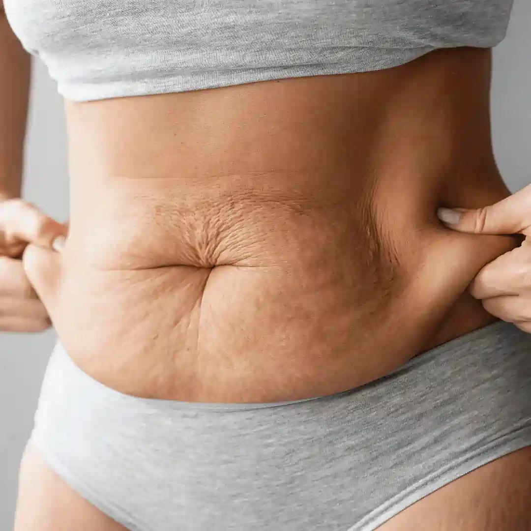 Is It Normal to Have Loose Skin After Pregnancy Somerset ?