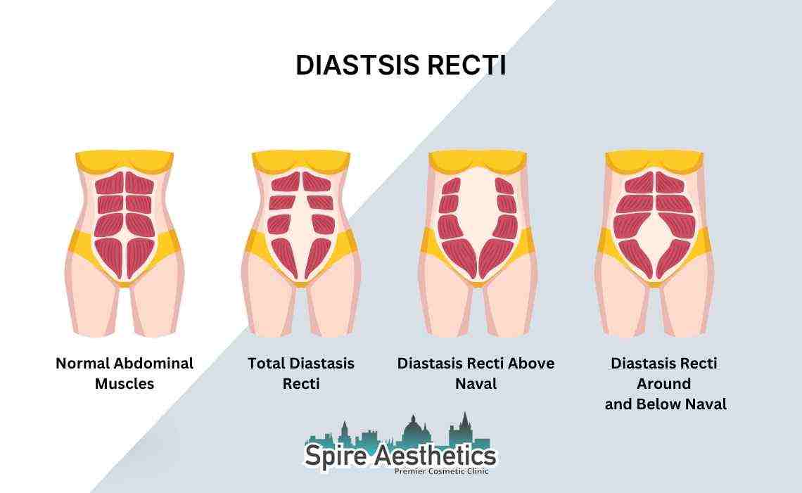 Is Non-Surgical Diastasis Recti Treatment Right for You? Common Concerns Answered Somerset